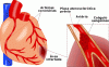 La angina de pecho puede ser el aviso de un infarto La angina de pecho puede ser el aviso de un infarto